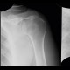 Calcified axillary lymph nodes: X-ray - Plain radiograph